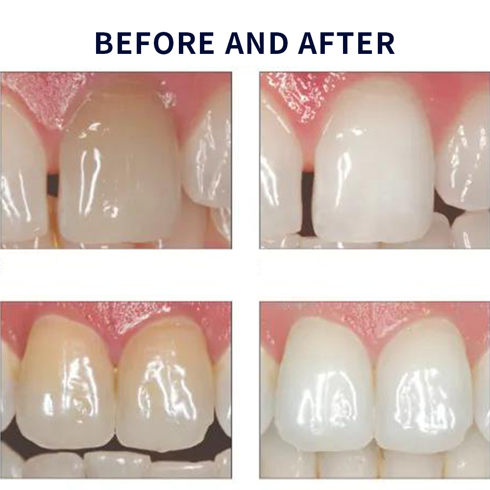 Opalescence Whitening 20% PF 2 – Teeth Whitening Led Kit recenzja i cena
