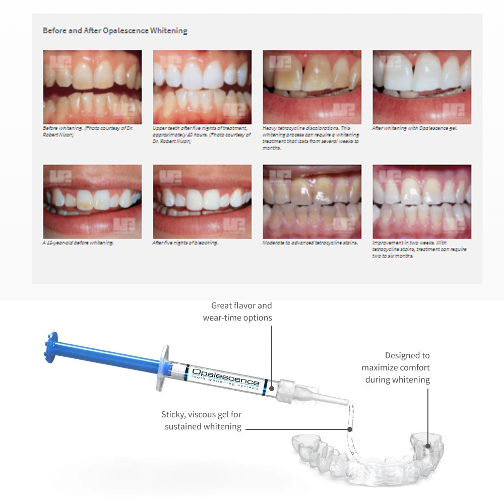 Opalescence Whitening 20% PF 2 – Teeth Whitening Led Kit recenzja i cena