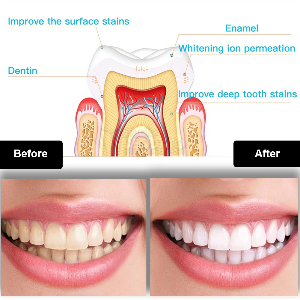 Zestaw do wybielania zębów den – Teeth Whitening Led Kit recenzja i cena